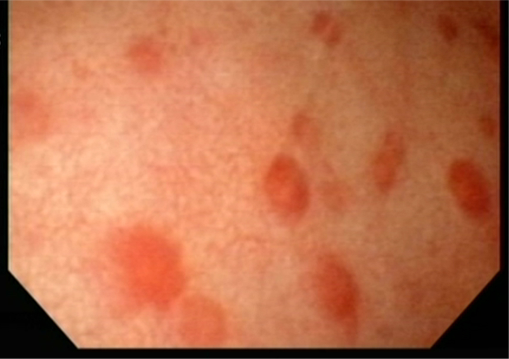 猫の膀胱炎の内視鏡写真